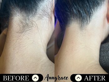 アングレイス(Anngrace)/【背中脱毛うなじ】Before/After