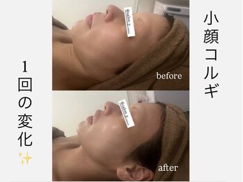 サロンワイアネシス(Salon y ANESIS)/小顔コルギ 1回の変化