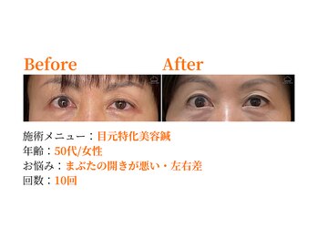 シルエラバレ(CiruelaValle)/Before After