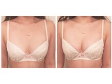 ラ ルミエール(La Lumiere)/下がりバストでお悩みの方へも