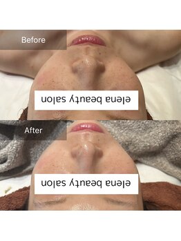 エレナ(Elena)/陶肌トリートメント