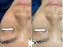 リシェス(Richesse)/シミ改善ハーブ★初回¥9990