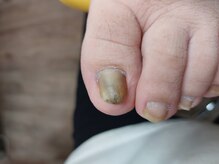 爪切り屋 足楽/肥厚・変色爪★【before】
