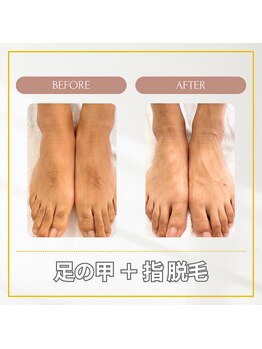 エクレ(EKURE)/足の甲+指脱毛