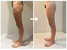 ラディアンス/凹凸解消