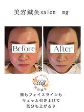 ミリグラム(mg)/【美容鍼灸６０分】
