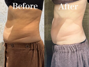 ディアーム 光明池店(Diarm)/韓国式脂肪分解レッドショット