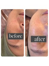 エマーチェ 自由が丘(emmace)/タラソトリートメント1回