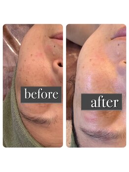 エマーチェ 自由が丘(emmace)/タラソトリートメント1回