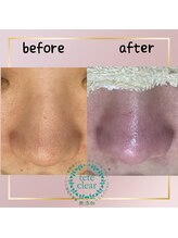 メイト(mate)/毛穴エクストラクションtete式