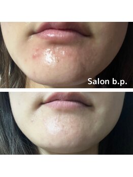 ビーピー 渋谷(b.p.)/ソフトハーブピーリング