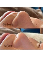 ブリリアントライフ(Blilyant life)/毛穴洗浄＋白玉酸素セラピー