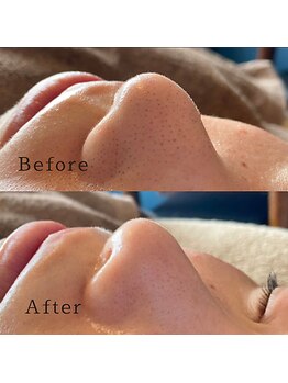 ブリリアントライフ(Blilyant life)/毛穴洗浄＋白玉酸素セラピー