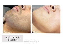 フィルムス(FILMS.)/ヒゲ脱毛のBeforeAfter