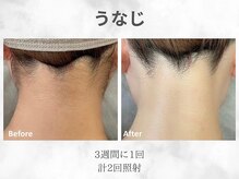 ベル(Belle)/レディースうなじ脱毛