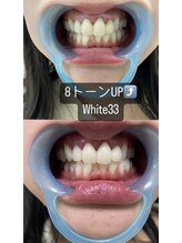 アイブロウ33 久留米店/【ホワイトニングBefore After】