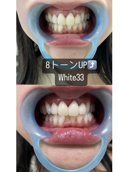アイブロウ33 久留米店/【ホワイトニングBefore After】