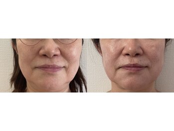 ブルーム(BLOOM)/たるみ改善　施術5回