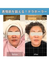 癒える(ielu)/小顔テラボーラー ★たるみケア