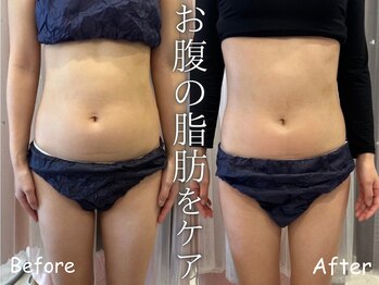 ボディーリセット 勝どき/≪脂肪冷却 before/after≫
