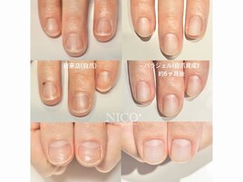 自爪育成中（自爪風仕上げ）