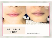 サロン ド メタセコイア(salon de Metasequoia)/【ジュニア脱毛】before／after