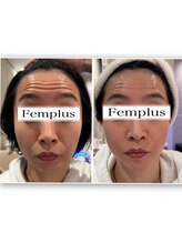 フェムプリュ(femplus)/サーモシェイプ小顔フェイシャル