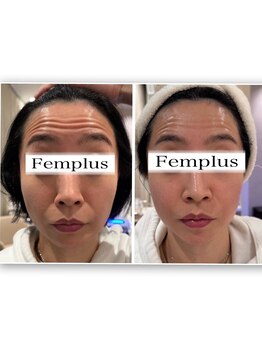 フェムプリュ(femplus)/サーモシェイプ小顔フェイシャル