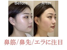 Q.顔のエラが気になります…。