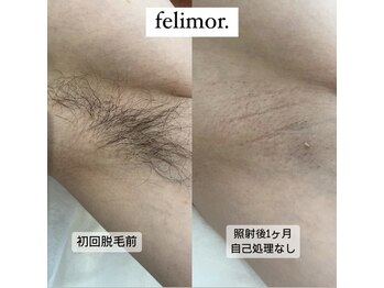 フェリモール(Felimor.)/メンズ光脱毛