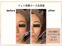 ビューティースリム リボーン 新宿店(reborn)/【フォト】1回の変化！