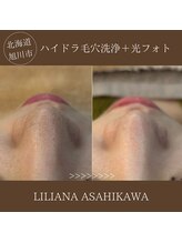 リリアーナ アサヒカワ(LILIANA ASAHIKAWA)/ハイドラ毛穴洗浄＋光フォト