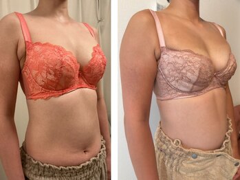 ハイファイブ(Hi-Five)/バストアップ/4回施術E→Gカップ