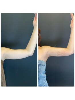 エステアンドヘアーサロン アルテ 札幌/肩も綺麗に見える脱毛