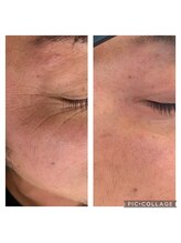 ヨロ 梅郷店(YOLO)/【シミ・しわの改善】