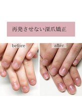 ティアラネイル(tiaranail)/再発させない深爪矯正