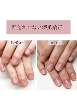 ティアラネイル(tiaranail)/再発させない深爪矯正