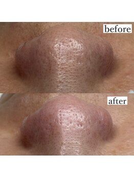 ライカブルー(RaicA BluE)/施術写真　before-after