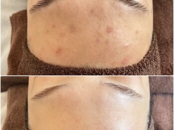 ベルエクラ(Bel Eclat)/ニキビBefore After/那覇