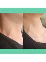 キザシ(kizashi)/【超リフト】＆【IPL光】