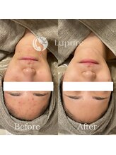 ルプレ(Lupure)/ハーブピーリング９回目