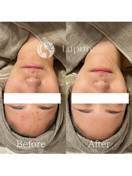 ルプレ(Lupure)/ハーブピーリング9回目