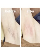 十美/両脇MIX脱毛