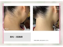 サロン ド メタセコイア(salon de Metasequoia)/【ジュニア脱毛】before／after