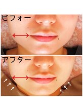 SDルーム/ラジオ波フェイシャル