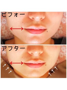 SDルーム/ラジオ波フェイシャル