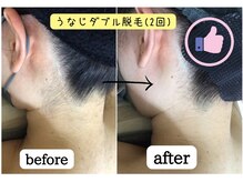 ジョエルワックス 沖縄コザ店(JOELLE WAX)/うなじダブル脱毛☆(2回)