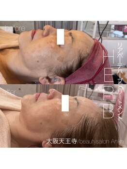 アンク(Ankh)/ワンランク上のハーブ施術