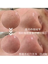 クレン(CLEN)/毛穴洗浄で色ムラのない肌へ