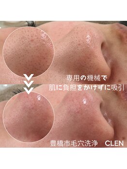クレン(CLEN)/毛穴洗浄で色ムラのない肌へ